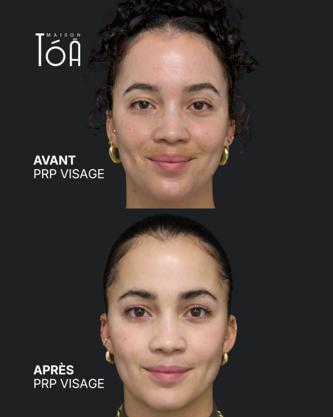 PRP visage avant après