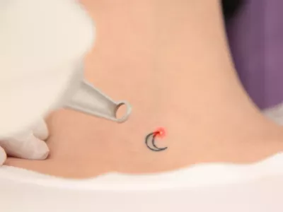détatouage