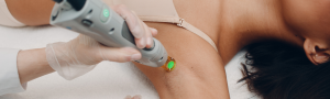epilationlaser