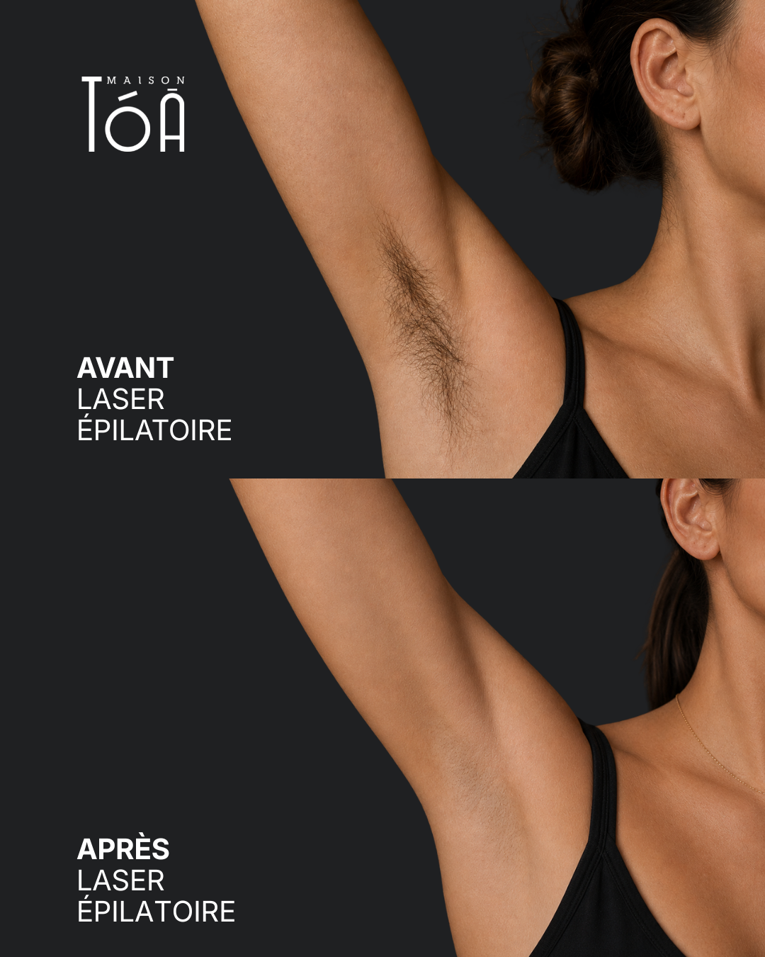 Épilation Laser Définitive 5 epilation laser aisselle