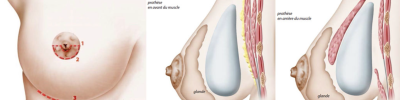 augmentation mammaire derrière le muscle