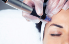 microneedling