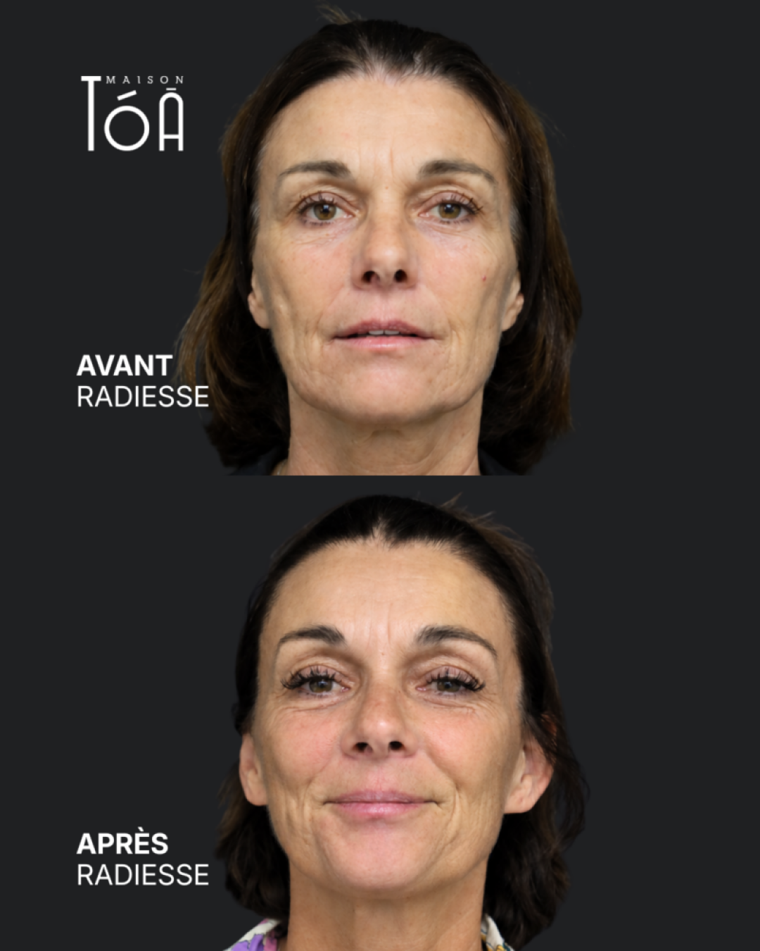 avant après radiesse
