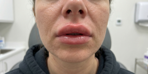 injection acide hyaluronique ratées