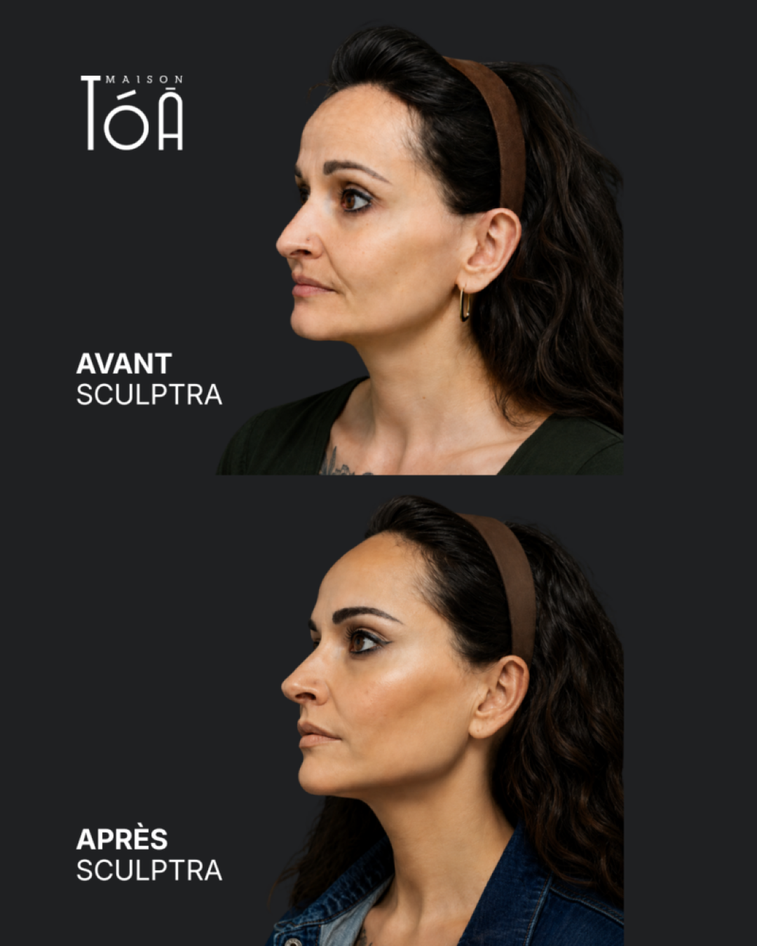 Avant Après profhilo 