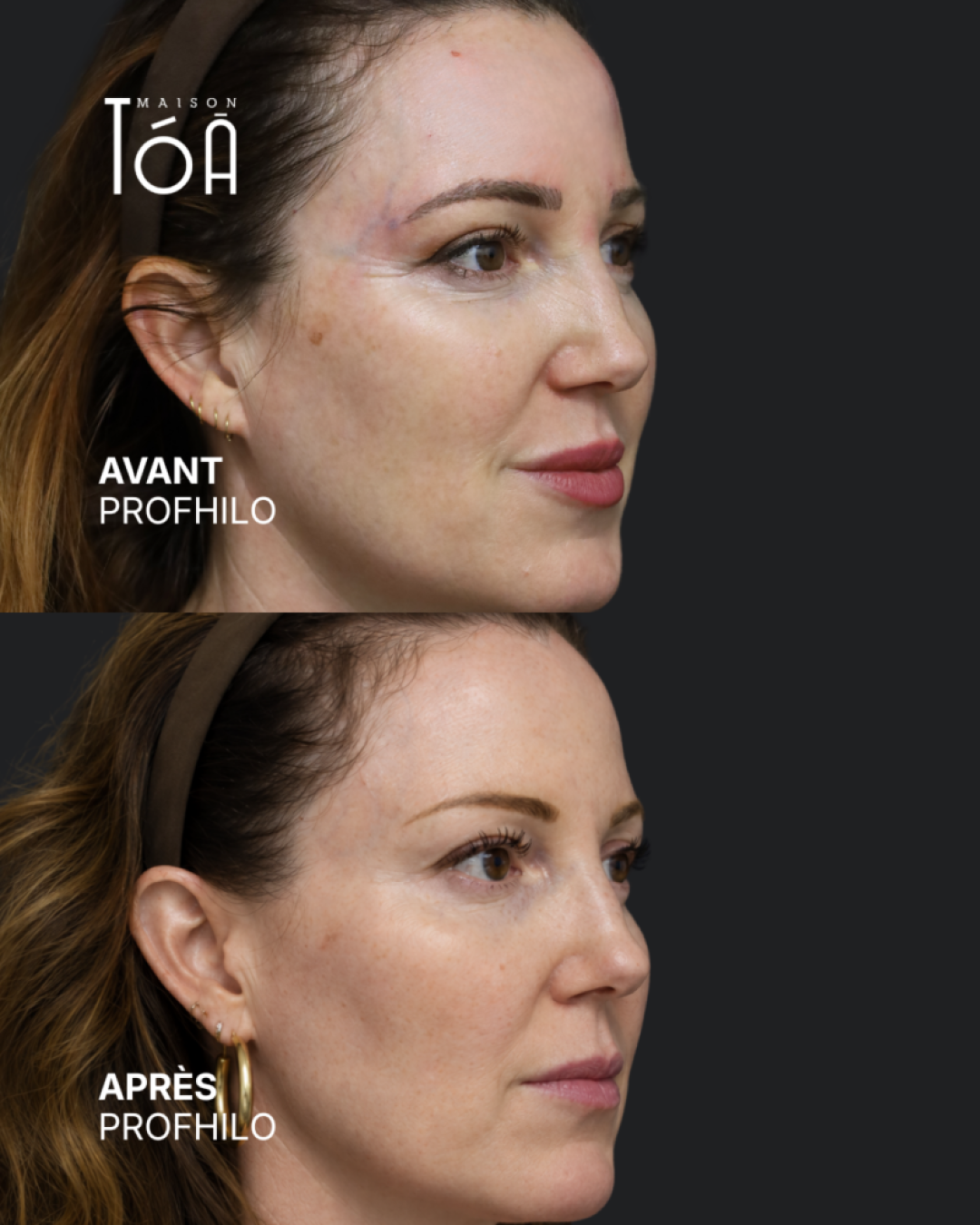 Profhilo® 8 Avant Après profhilo