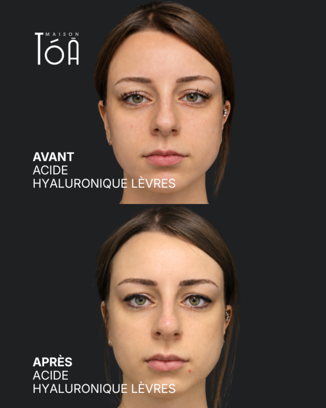 Acide hyaluronique avant après