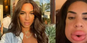 acide hyaluronique raté photos