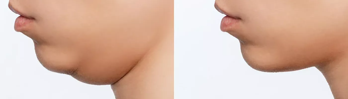 Double_chin