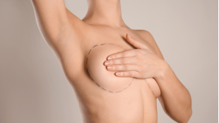 Réduction mammaire 11 chirurgie mammaire