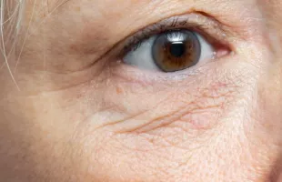 rides sous les yeux injections