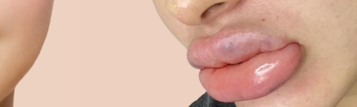 lèvres mal injectées