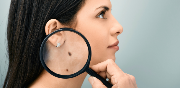 Acide Hyaluronique 88 Excision des grains de beaute