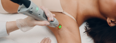 epilationlaser