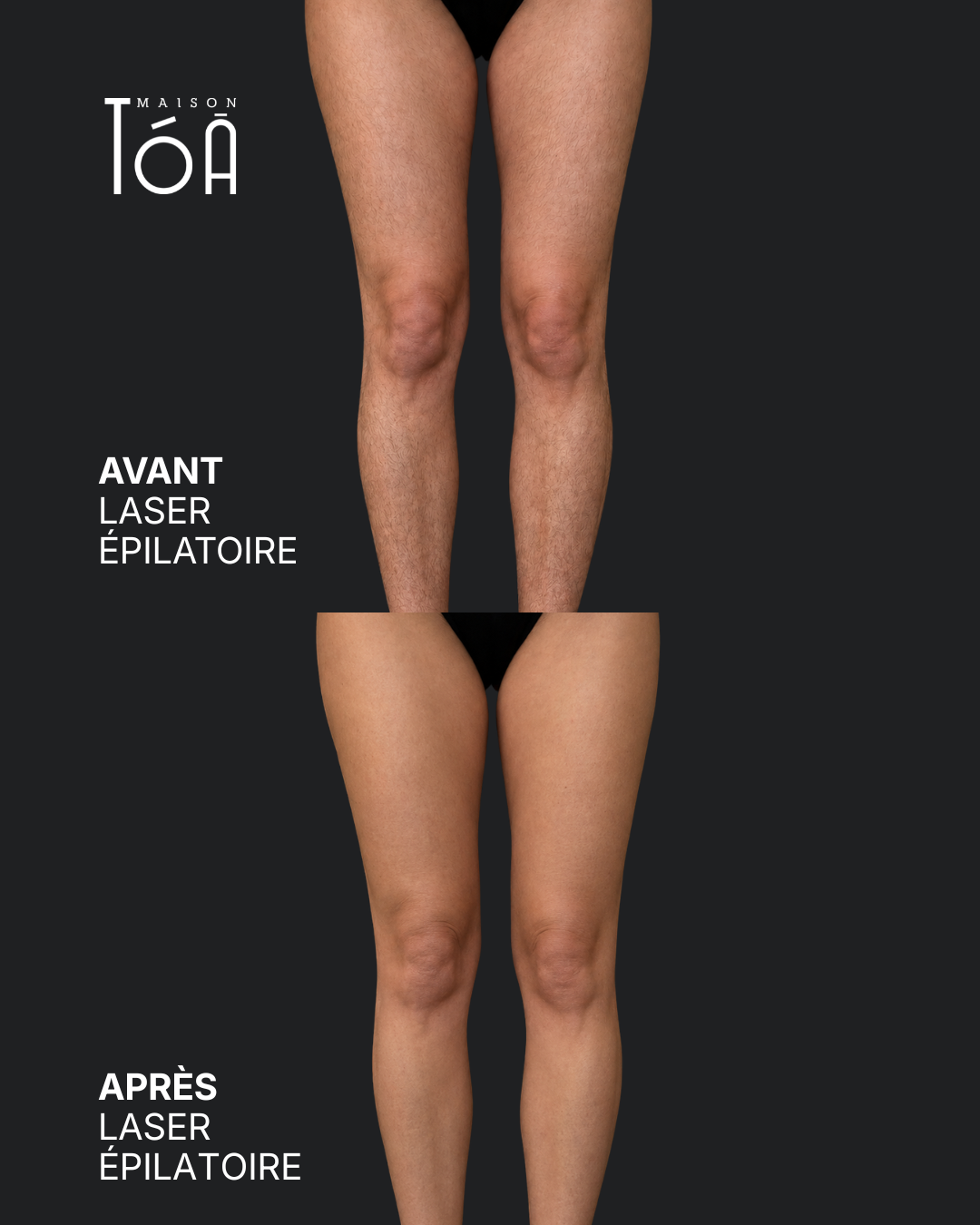 Épilation Laser Définitive 6 epilation laser jambes