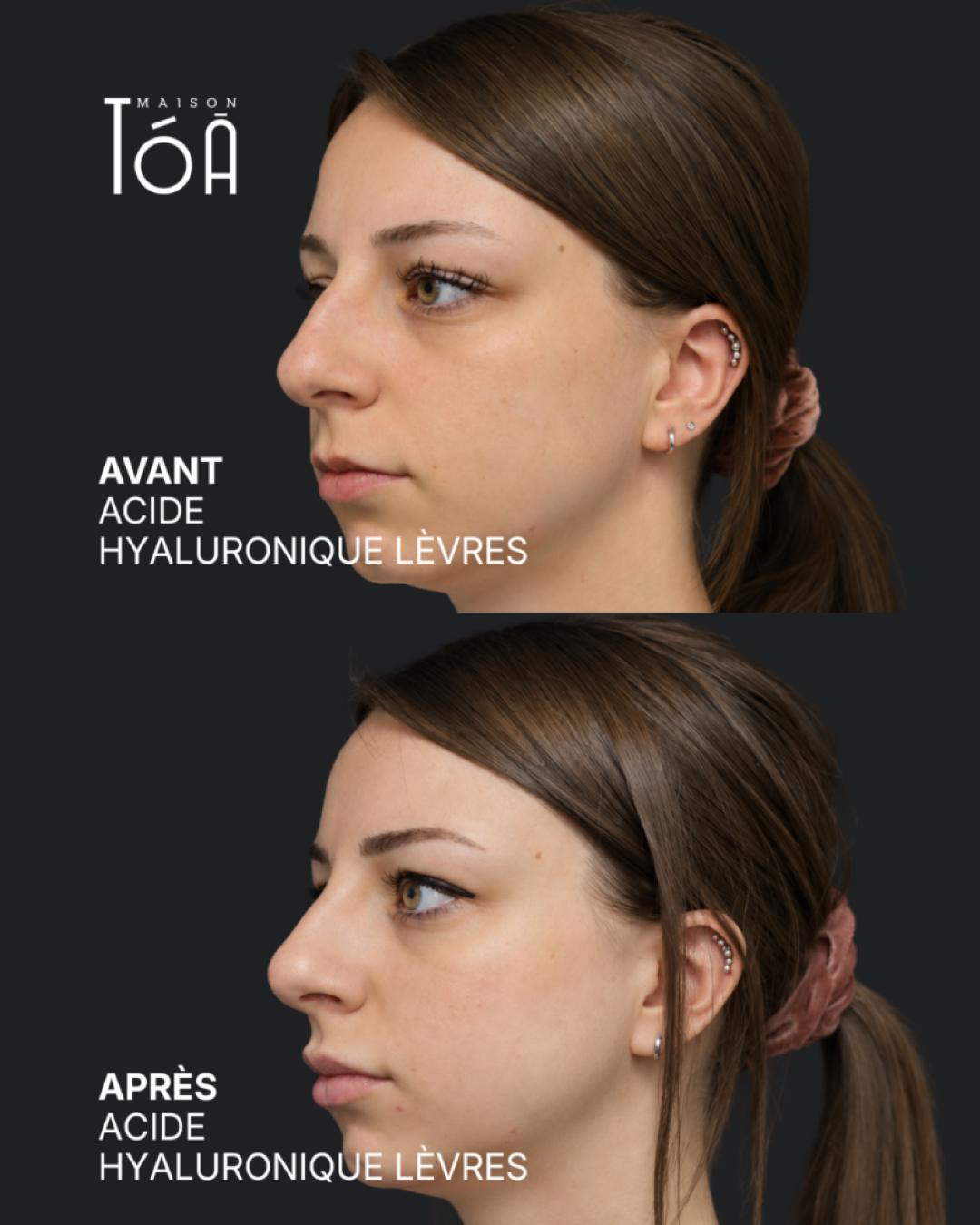 Acide hyaluronique avant après
