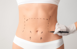 abdominoplastie