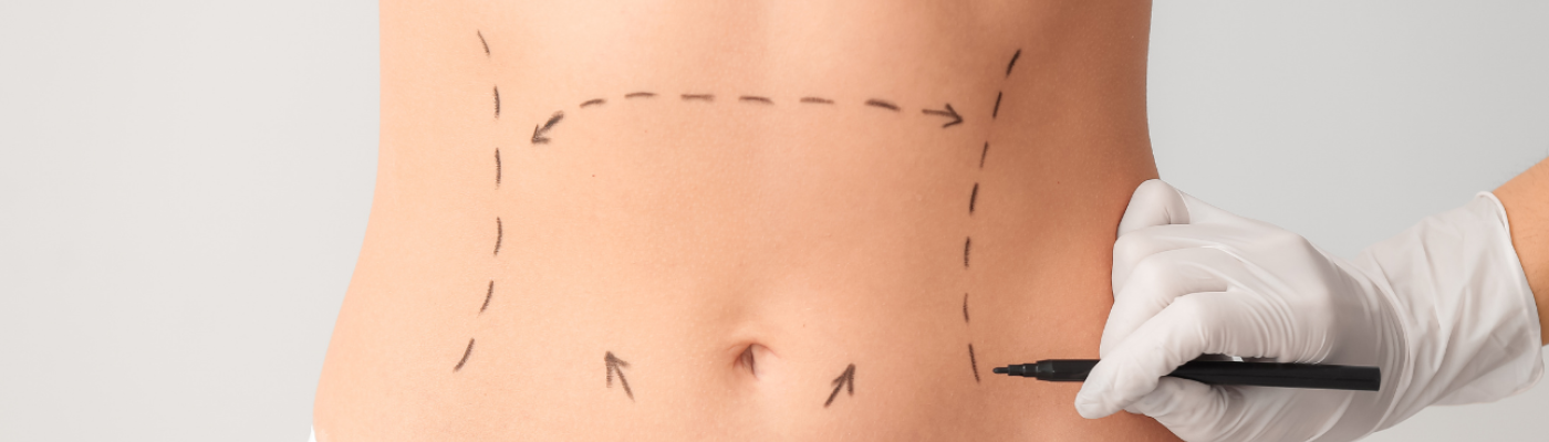 abdominoplatie