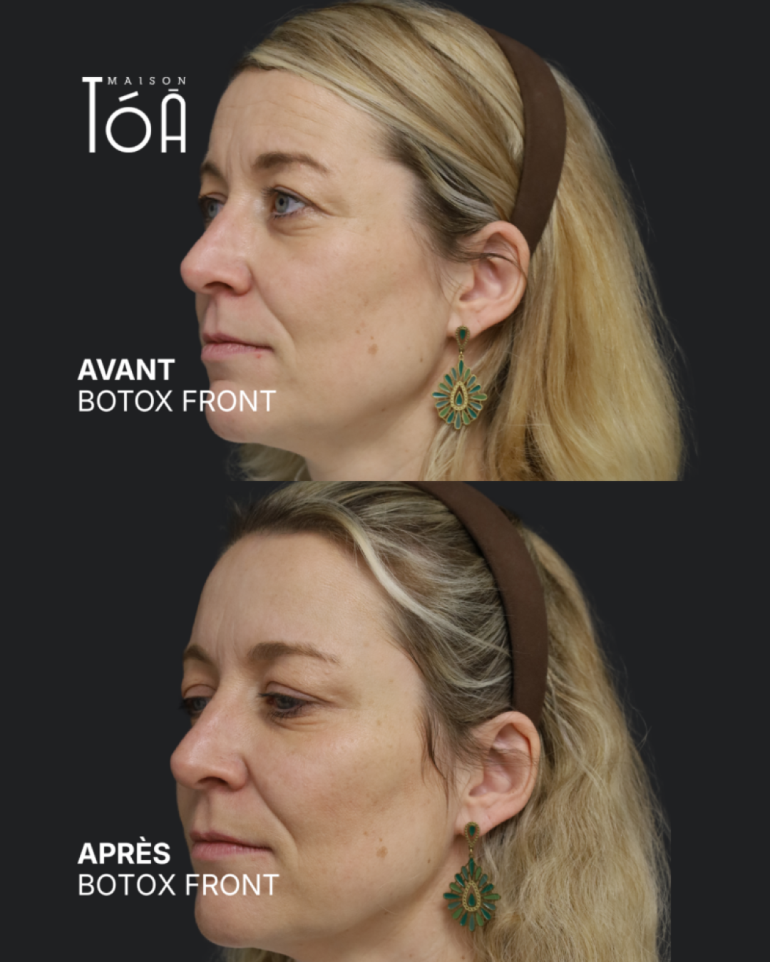 Botox 7 Avant/après toxine botulique, résultat 3, Maison Tóā Lausanne