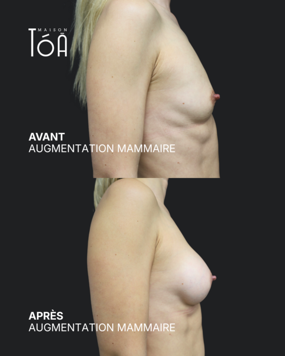 Augmentation mammaire 9 Augmentation mammaire avant/après, résultat 5, Maison Tóā Lausanne