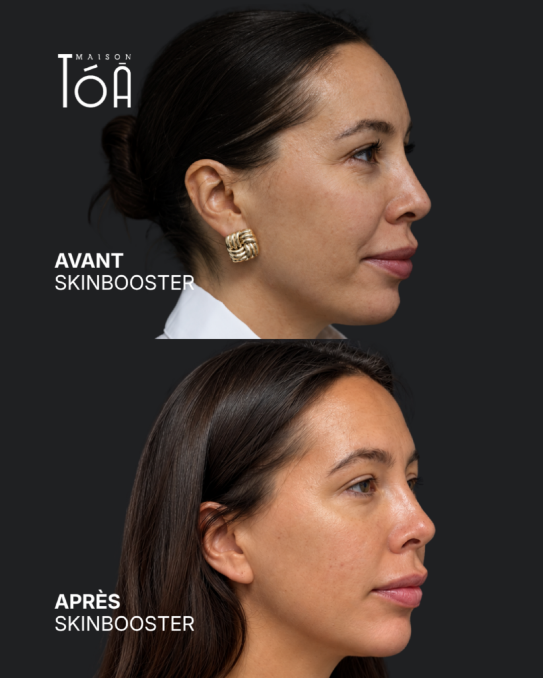Skinbooster 5 Skinbooster avant / après — cas 1, Maison Tóā Lausanne