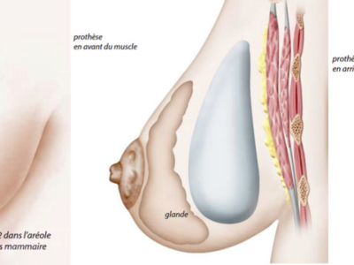 augmentation mammaire devant ou derriere le muscle