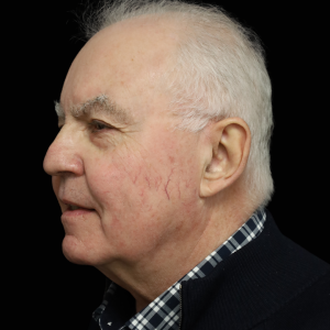 laser vasulaire lausanne