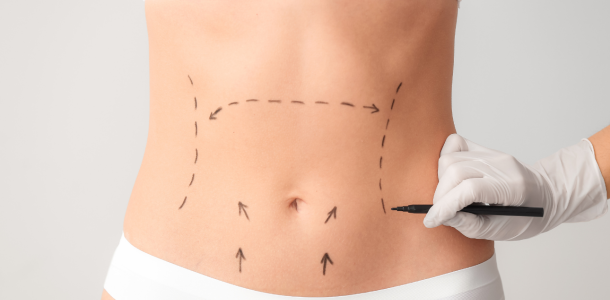 abdominoplatie