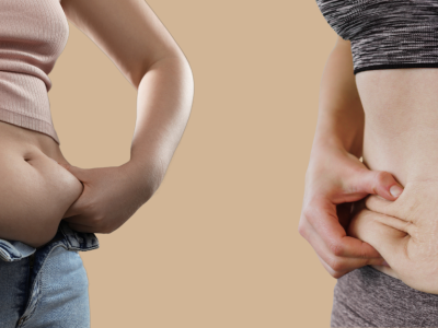 Liposuccion vs abdominoplastie